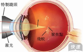 飞蚊症的治疗方法,中西医结合，科学应对眼部困扰”